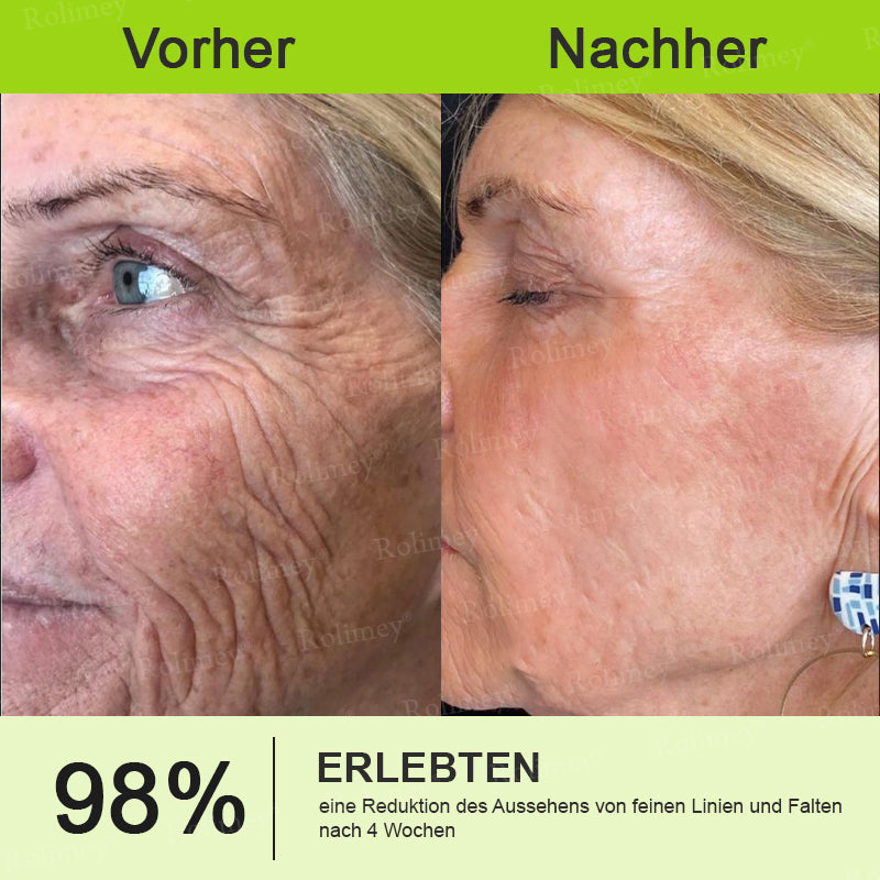 Jetzt jugendliche Haut zurückgewinnen 🍀Rolimey® Botox & Vita-A Retinol Shot Falten-Lift Straffungscreme