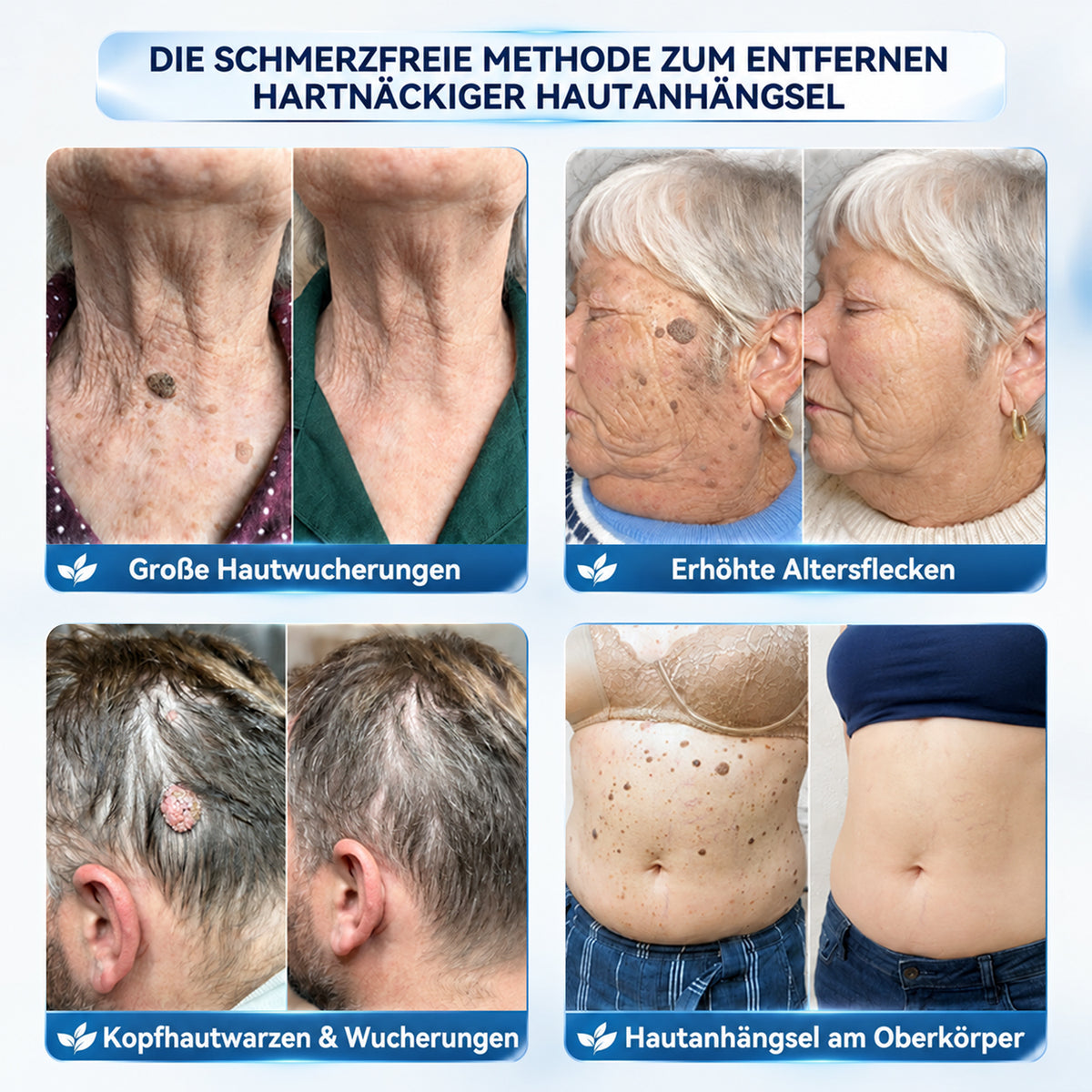 Dyceco® 🚑𝟕-𝐓𝐚𝐠𝐞 𝐇𝐚𝐮𝐭𝐚𝐧𝐡ä𝐧𝐠𝐬𝐞𝐥- & 𝐅𝐥𝐞𝐜𝐤𝐞𝐧-𝐄𝐧𝐭𝐟𝐞𝐫𝐧𝐮𝐧𝐠𝐬𝐜𝐫𝐞𝐦𝐞(𝐒𝐜𝐡𝐦𝐞𝐫𝐳𝐟𝐫𝐞𝐢𝐞 𝐅𝐨𝐫𝐦𝐞𝐥 – 𝐨𝐡𝐧𝐞 𝐍𝐚𝐫𝐛𝐞𝐧)