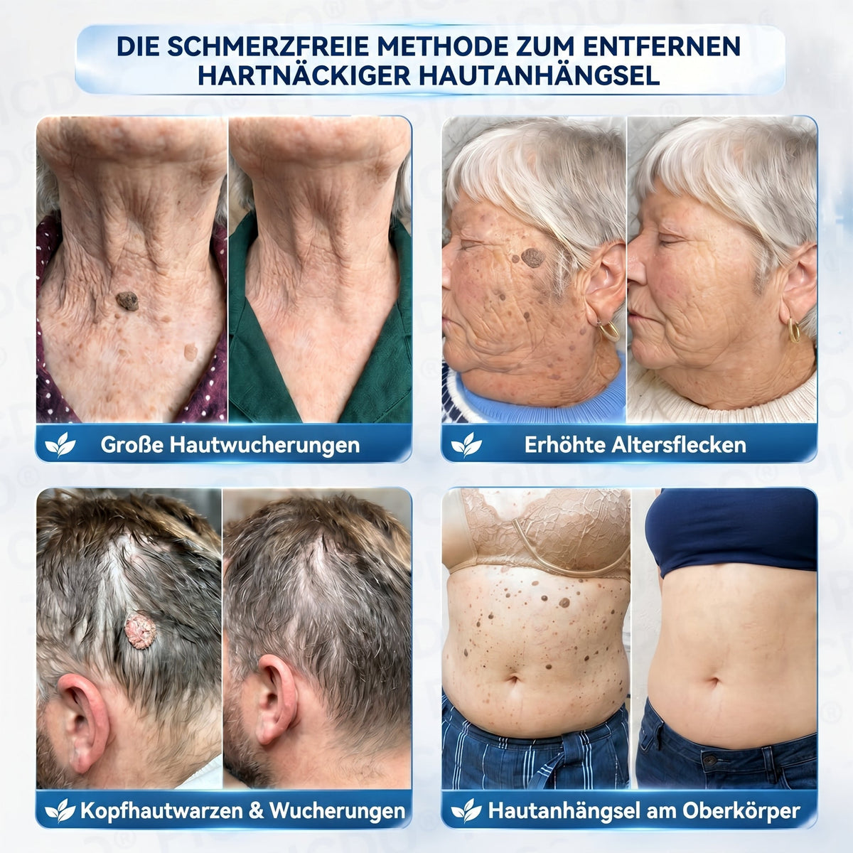 𝐏𝐢𝐜𝐝𝐨® 𝟕-𝐓𝐚𝐠𝐞 𝐇𝐚𝐮𝐭𝐚𝐧𝐡ä𝐧𝐠𝐬𝐞𝐥- & 𝐅𝐥𝐞𝐜𝐤𝐞𝐧-𝐄𝐧𝐭𝐟𝐞𝐫𝐧𝐮𝐧𝐠𝐬𝐜𝐫𝐞𝐦𝐞(𝐒𝐜𝐡𝐦𝐞𝐫𝐳𝐟𝐫𝐞𝐢𝐞 𝐅𝐨𝐫𝐦𝐞𝐥 – 𝐨𝐡𝐧𝐞 𝐍𝐚𝐫𝐛𝐞𝐧) 🎄