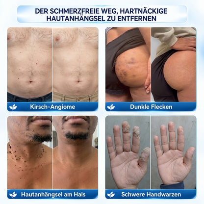 Dyceco® 🚑𝟕-𝐓𝐚𝐠𝐞 𝐇𝐚𝐮𝐭𝐚𝐧𝐡ä𝐧𝐠𝐬𝐞𝐥- & 𝐅𝐥𝐞𝐜𝐤𝐞𝐧-𝐄𝐧𝐭𝐟𝐞𝐫𝐧𝐮𝐧𝐠𝐬𝐜𝐫𝐞𝐦𝐞(𝐒𝐜𝐡𝐦𝐞𝐫𝐳𝐟𝐫𝐞𝐢𝐞 𝐅𝐨𝐫𝐦𝐞𝐥 – 𝐨𝐡𝐧𝐞 𝐍𝐚𝐫𝐛𝐞𝐧)