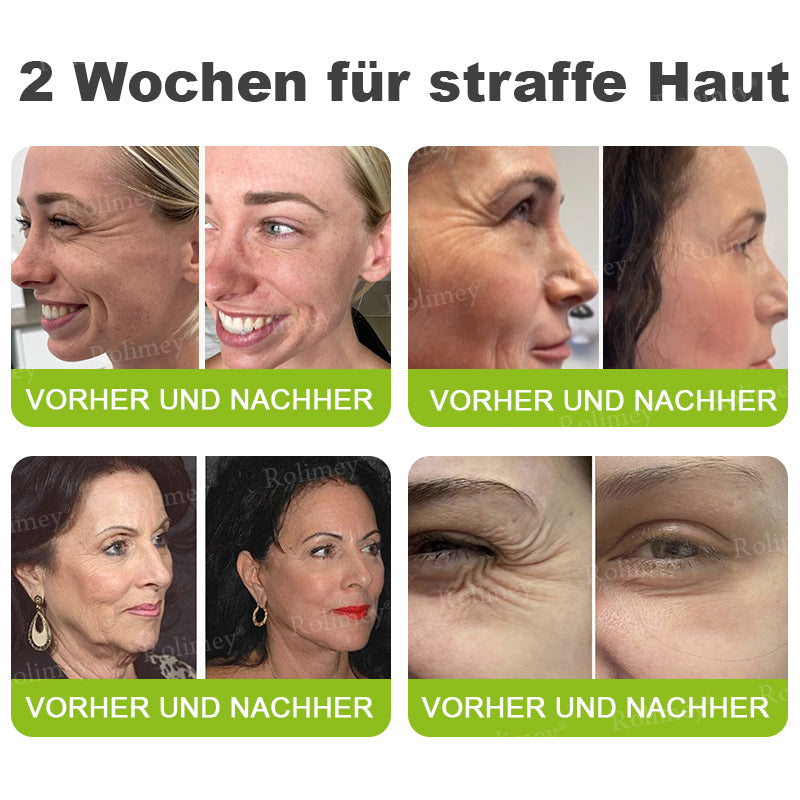 Jetzt jugendliche Haut zurückgewinnen 🍀Rolimey® Botox & Vita-A Retinol Shot Falten-Lift Straffungscreme