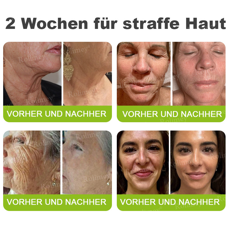 Jetzt jugendliche Haut zurückgewinnen 🍀Rolimey® Botox & Vita-A Retinol Shot Falten-Lift Straffungscreme